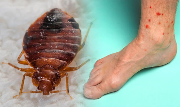 Troy Bed Bug Bites